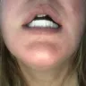 Instasmile - Painful horse teeth - 700 $ - worst experience ever!!