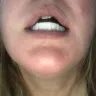 Instasmile - Painful horse teeth - 700 $ - worst experience ever!! - Photo 3