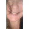Instasmile - Painful horse teeth - 700 $ - worst experience ever!! - Photo 7