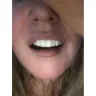 Instasmile - Painful horse teeth - 700 $ - worst experience ever!! - Photo 2