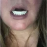 Instasmile - Painful horse teeth - 700 $ - worst experience ever!!
