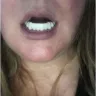 Instasmile - Painful horse teeth - 700 $ - worst experience ever!! - Photo 4