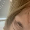 Allergan - Juvederm injections - Photo 3