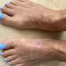 Saks Fifth Avenue - Ill fitting sandal that caused bleeding blisters - Photo 2