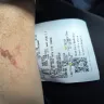 Popeyes - I received second/third degree burns. - Photo 4