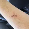 Popeyes - I received second/third degree burns. - Photo 5
