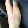 Popeyes - I received second/third degree burns. - Photo 7