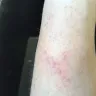 Popeyes - I received second/third degree burns. - Photo 1