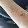 Popeyes - I received second/third degree burns. - Photo 2