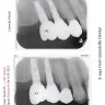 Grandville Dental Health Center PC - Full mouth restoration - dental crowns & bridges