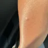 Riu Republica Hotel Adults Only - Bed bug bites