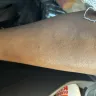 Riu Republica Hotel Adults Only - Bed bug bites