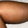 Riu Republica Hotel Adults Only - Bed bug bites