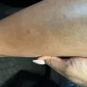 Riu Republica Hotel Adults Only - Bed bug bites