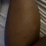 Riu Republica Hotel Adults Only - Bed bug bites