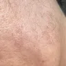 LaserAway Medical Group - No results facial hair increased (do not recommend) - Photo 2