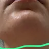 LaserAway Medical Group - No results facial hair increased (do not recommend) - Photo 1