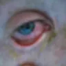 Acuvue - Severe eye damage from acuvue