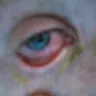 Acuvue - Severe eye damage from acuvue - Photo 1