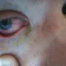Acuvue - Severe eye damage from acuvue - Photo 2