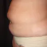Laser Body Sculpting - Disfiguring results, false advertsing, deceptive selling practices - Photo 3