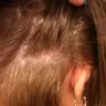 Empire Beauty School - chemical burn scalp - Photo 1