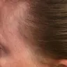 Empire Beauty School - chemical burn scalp