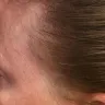Empire Beauty School - chemical burn scalp - Photo 2