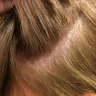 Empire Beauty School - chemical burn scalp