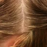 Empire Beauty School - chemical burn scalp - Photo 5