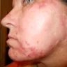 NuBrilliance - Damage to face - Photo 1