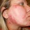NuBrilliance - Damage to face - Photo 3