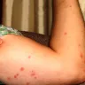 British Airways - bedbugs - Photo 1