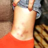 British Airways - bedbugs - Photo 2