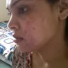 mandys facial hair remover - facial burns and scarring