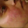 mandys facial hair remover - facial burns and scarring