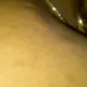 Choice Hotels - bed bugs - Photo 5