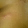 Choice Hotels - bed bugs - Photo 6