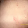 Qatar Airways - bug bites from the seat - Photo 2