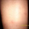 Qatar Airways - bug bites from the seat - Photo 3