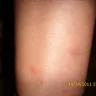 Qatar Airways - bug bites from the seat - Photo 4