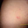 Qatar Airways - bug bites from the seat - Photo 5