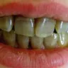 Pfizer - teeth stained by tetracycline