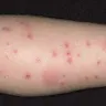 InTown Suites - Bed Bugs - Photo 1