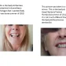 Coast Dental Services - replaced tooth, cost over $700 and still look weird. - Photo 1