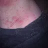 Aflac - not covering on accident - Photo 1