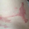 Emirates - severe burn - unanswered complaint - Photo 1