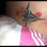 Mirena IUD - Reaction - Photo 1