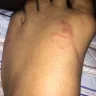 Sandals Resorts - Poor service and scabies - Photo 1