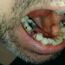 Western Dental Services - tooth extraction